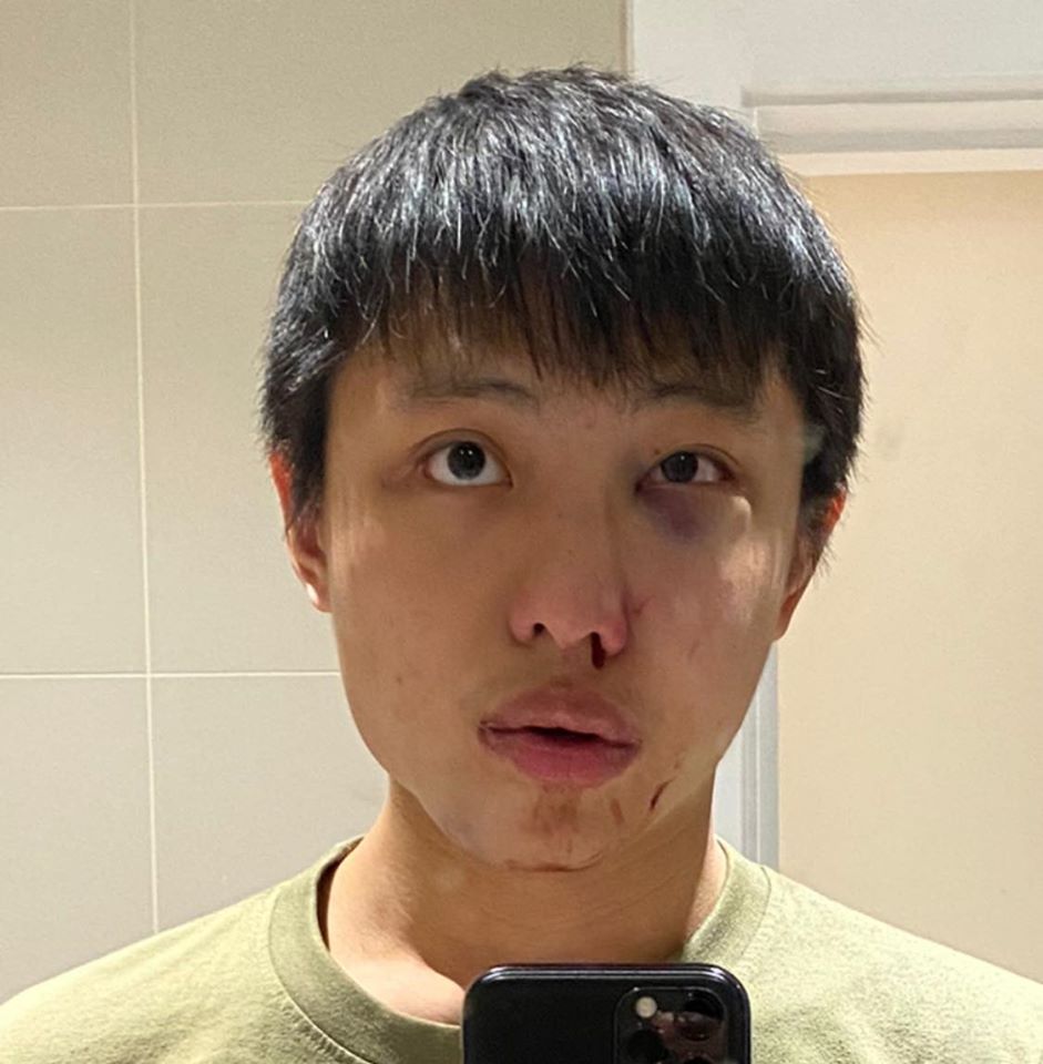 Estudiante de Singapur denuncia agresiones racistas por pánico al coronavirus